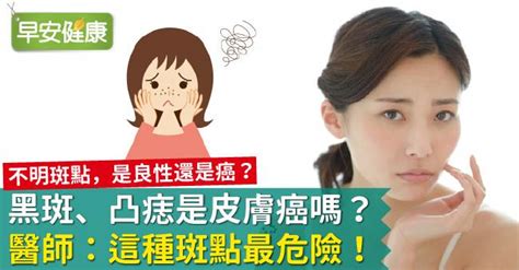 手臂黑斑|黑斑、臉上皮膚長黑點，是皮膚癌嗎？皮膚科醫師：這…